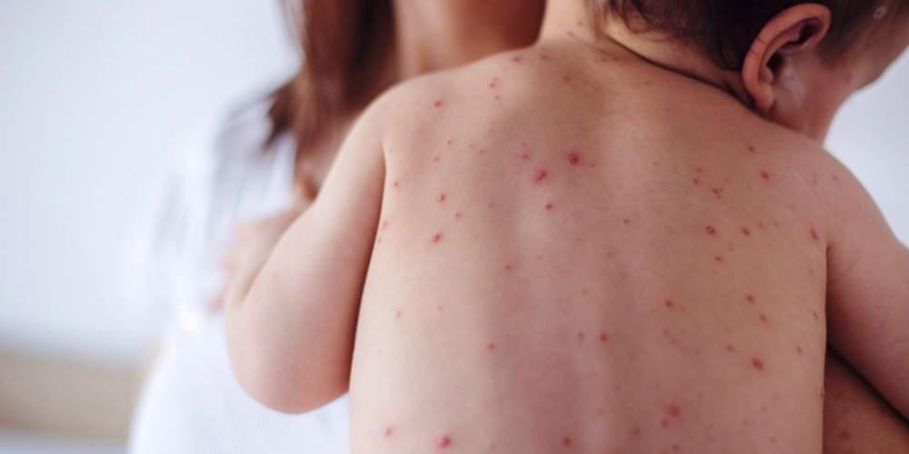 SOS από το ΚΕΕΛΠΝΟ: Eίμαστε σε φάση επιδημικής έξαρσης της ιλαράς
