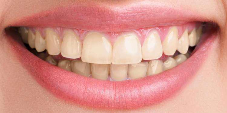 Κατάχρηση στη λεύκανση δοντιών κάνουν οι Ελληνες