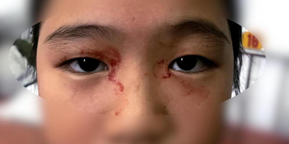 Η 11χρονη που ιδρώνει... αίμα - Πάσχει από σπάνια πάθηση λόγω στρες [εικόνες]