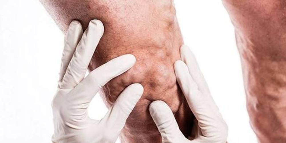 Κιρσοί στους άντρες: Σύγχρονες και ανώδυνες λύσεις