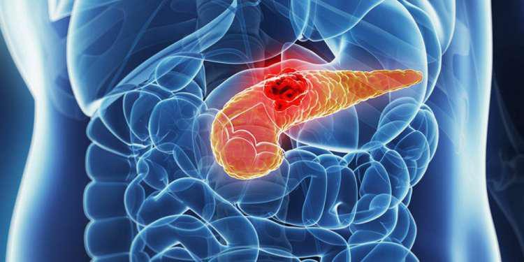 Καρκίνος παγκρέατος: Αυξημένη κατά 5% η θνησιμότητα στην Ευρώπη – Ανεπαρκής η χρηματοδότηση έρευνας