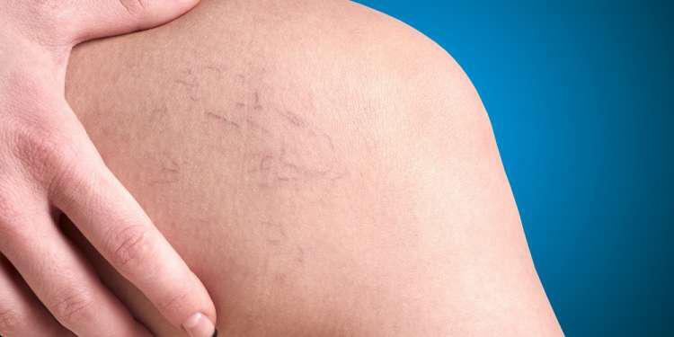 Εξαφανίστε χωρίς πόνο τις ευρυαγγείες