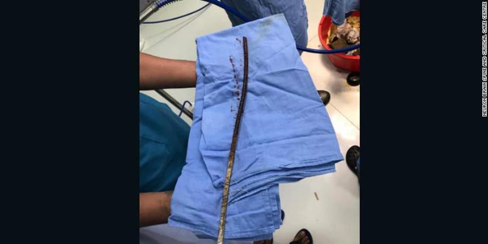 Αδιανόητο: Λοστός διαπέρασε το κρανίο του κι όμως επέζησε [εικόνες]