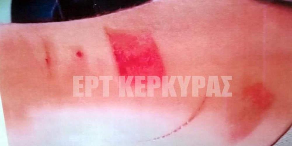 Τι έδειξε η ιατροδικαστική εξέταση του 19χρονου που κατήγγειλε βασανιστήρια σε εστιατόριο στην Κέρκυρα