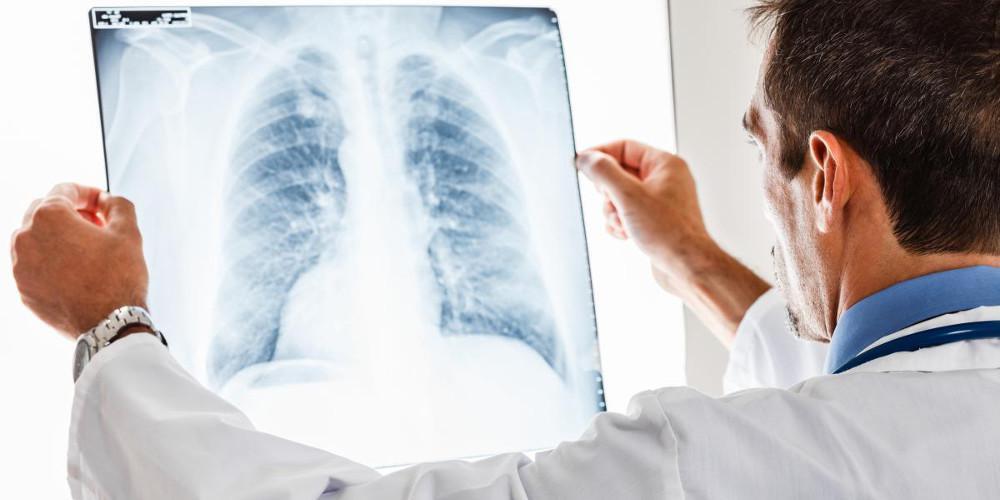 Καρκίνος του πνεύμονα: Η ατμοσφαιρική ρύπανση από μικροσωματίδια δεύτερη σημαντικότερη αιτία μετά το κάπνισμα