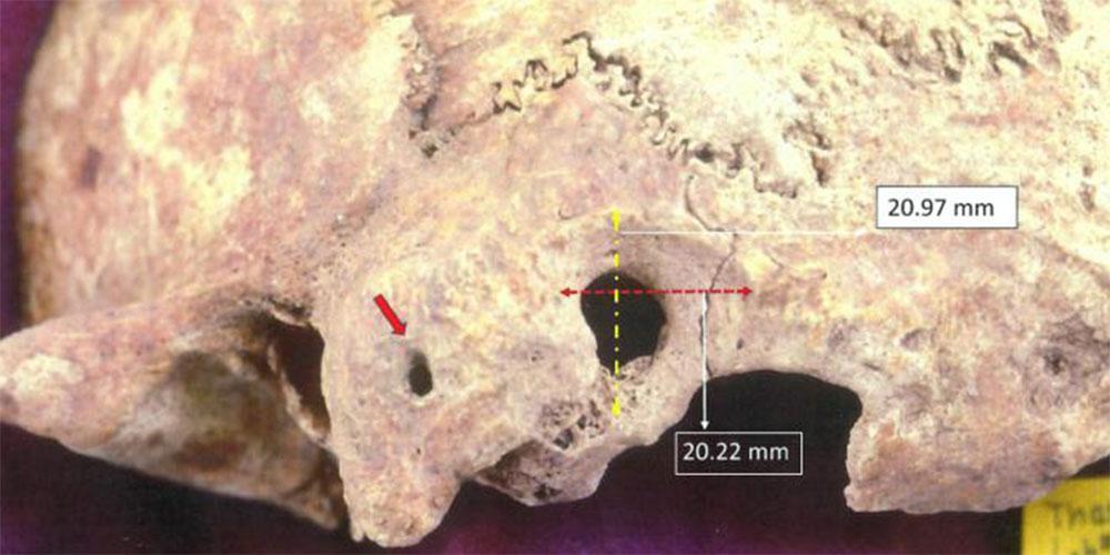 Θάσος: Εντοπίστηκε κρανίο πρωτοβυζαντινής περιόδου με ενδείξεις πολύπλοκης χειρουργικής επέμβασης