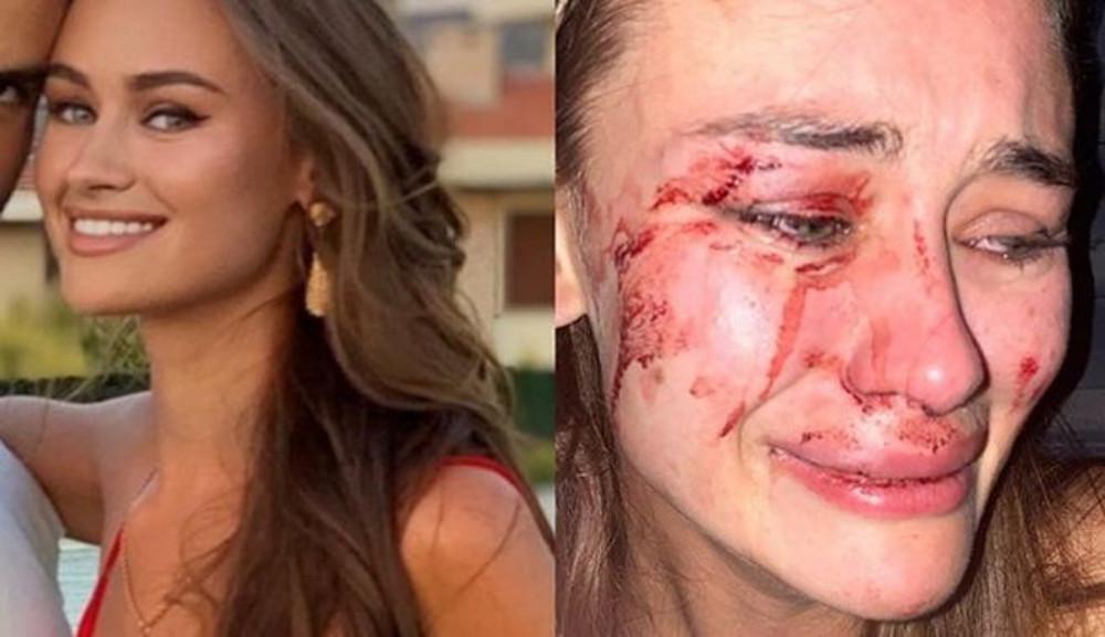 O ξυλοδαρμός του μοντέλου από την Ουκρανία ξεσήκωσε τις τουρκικές αρχές: Έκλεισε η πιο διάσημη πλαζ της χώρας