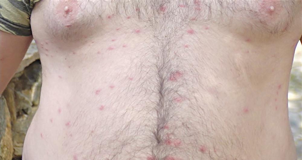 Τρόμος στην Κρήτη: Ολόκληρο χωρίο βγάζει περίεργα εξανθήματα