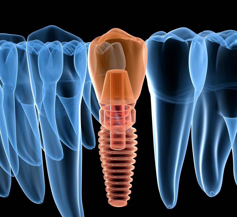 Οδοντικά εμφυτεύματα. Είναι κατάλληλα για όλους;