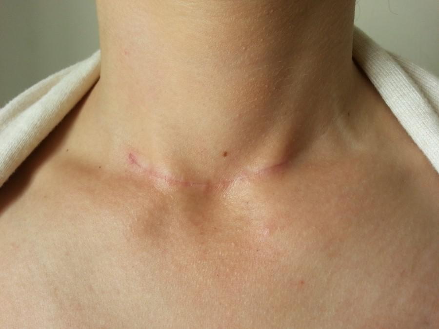 Αφαίρεση θυρεοειδούς χωρίς «σημάδι» στο λαιμό