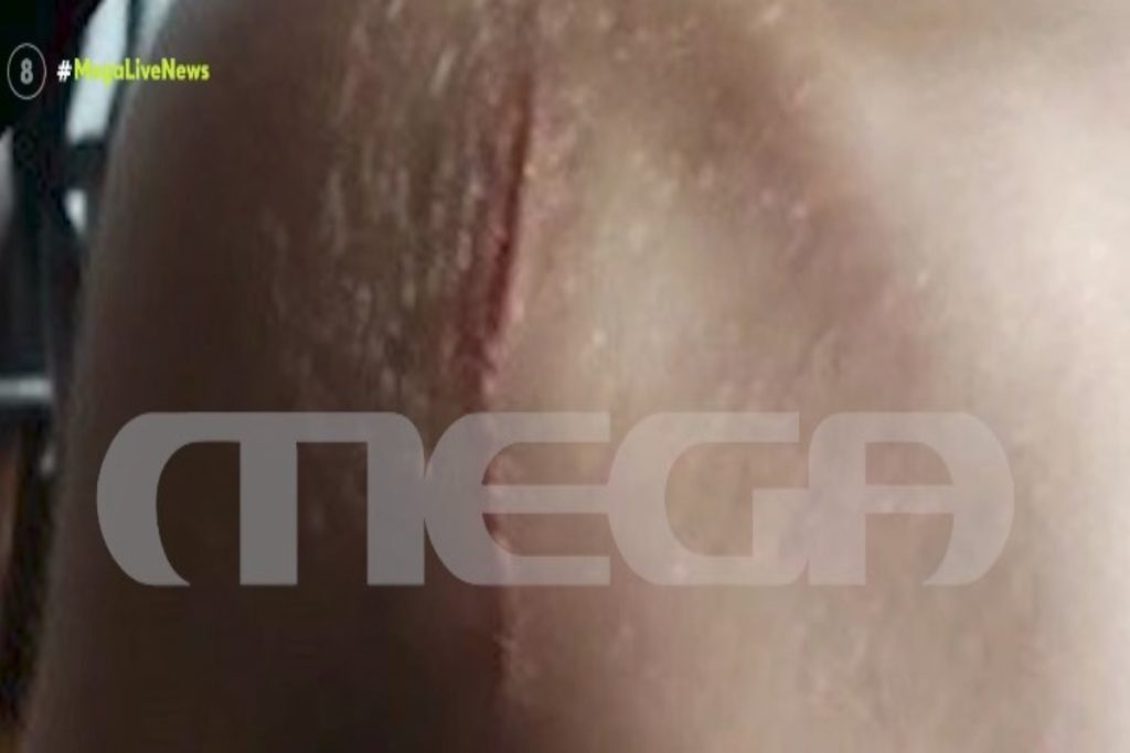 Bullying στα σχολεία: «Μαχαίρωσαν το παιδί μου με φαλτσέτα μέσα στο σχολείο» – Σοκάρει η εικόν