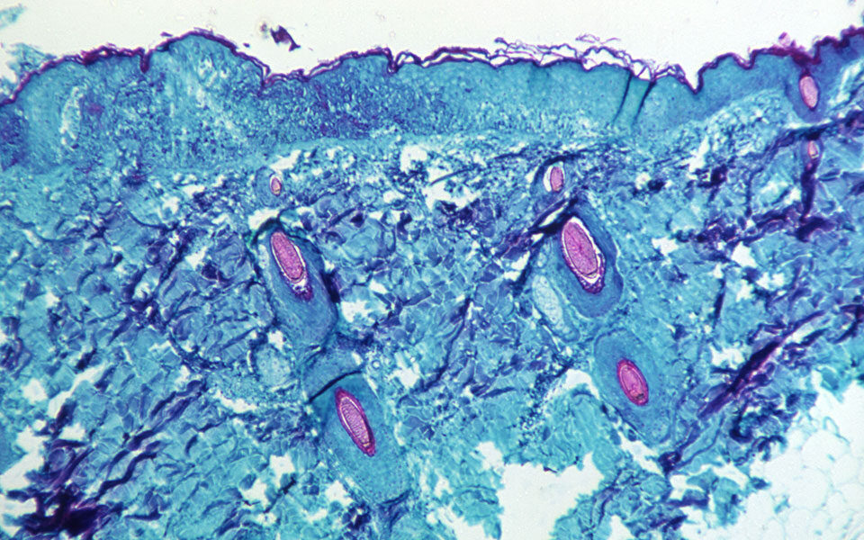 ευλογιά των πιθήκων