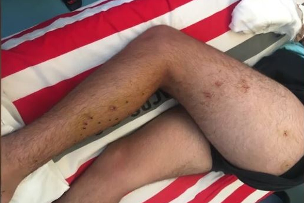 Αλεποχώρι: Φωτογραφίες ντοκουμέντο από τα τραύματα του 14χρονου