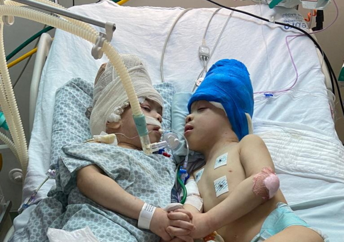 Βραζιλία σιαμαία