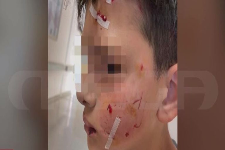 Επίθεση σκύλου σε 13χρονο στο Λαγονήσι: «Οι ιδιοκτήτες είχαν ξεχάσει την πόρτα ανοιχτή»