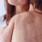 Προειδοποίηση από τις βρετανικές Αρχές στους ταξιδιώτες για την αύξηση κρουσμάτων ιλαράς στην Ευρώπη