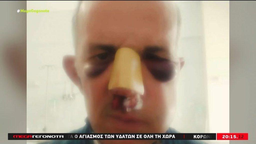 Περιστέρι: Άγριος ξυλοδαρμός 58χρονου γιατί έκανε παρατήρηση για παράνομη στάθμευση