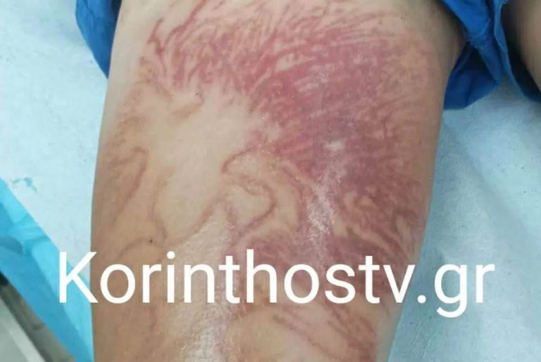 Σοκ στην Κόρινθο: Στο νοσοκομείο 9χρονος που δέχτηκε τσίμπημα από θαλάσσια ανεμώνη