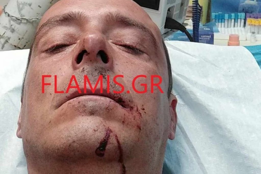 Πάτρα: Θύμα ξυλοδαρμού ένας 47χρονος – «Με χτυπούσαν και με κλωτσούσαν 4 άτομα»