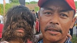 σύνδρομο τρίχες