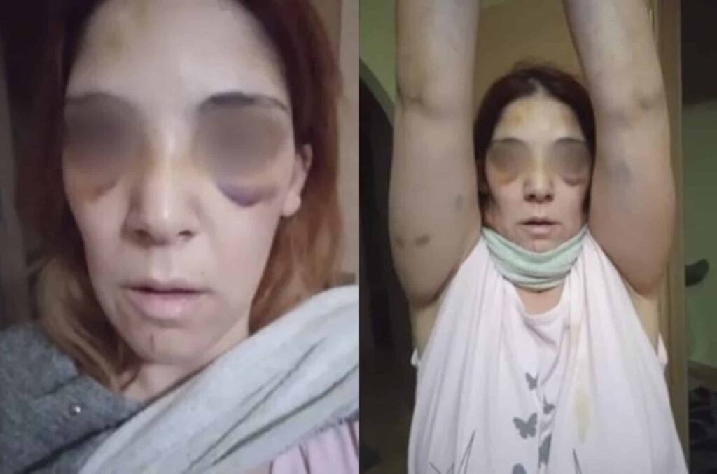 Σοκαριστική η εικόνα της 32χρονής από το Άργος – Εμφανίστηκε OnAir με μώλωπες στο πρόσωπο [Βίντεο]