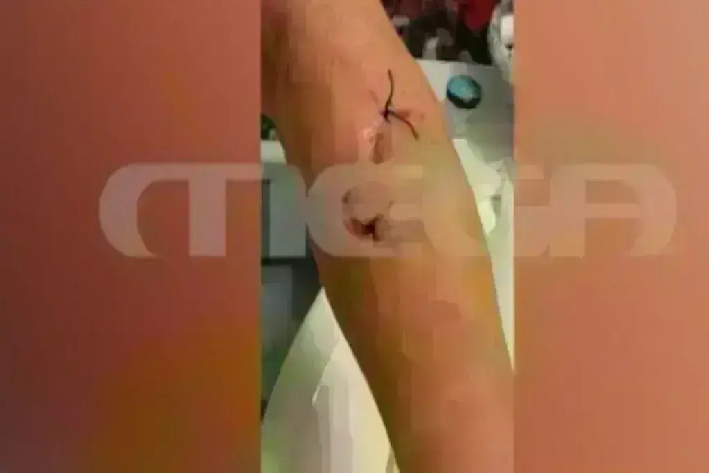 Ραφήνα: Τρομοκρατημένη η γυναίκα που δέχθηκε επίθεση από σκυλιά – «Με έριξαν κάτω και άρχισαν 