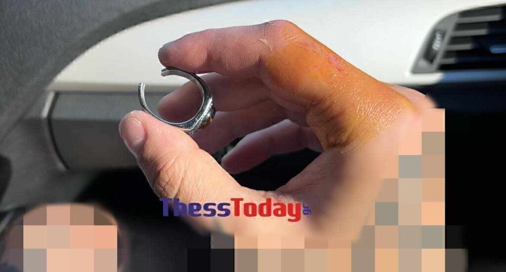 Χαλκιδική: Γιατροί παρακολούθησαν βίντεο στο Youtube για να αφαιρέσουν δαχτυλίδι από χέρι ασθενούς κ
