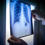 Πνευμονία: Διάγνωση – Θεραπεία – Πρόληψη