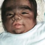 Αποκάλυψη: Αυτός είναι ο λόγος για τα μωρά με «σύνδρομο λυκάνθρωπου» – Το προκαλεί δημοφιλές φάρμακο για τη φαλάκρα