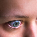 Τι σημαίνουν τα γουρλωμένα μάτια για τον θυρεοειδή που νοσεί