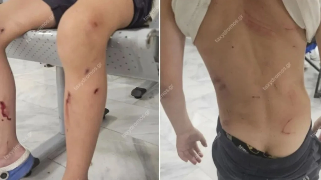 Βόλος: Αδέσποτα επιτέθηκαν άγρια σε 7χρονο – «Παραλίγο να τον κατασπαράξουν», λέει η μητέρα του
