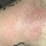 Κόντεψε να πεθάνει από ένα σπυρί: Πήγε στο νοσοκομείο αφού εξελίχθηκε σε απόστημα – Τι είναι η σήψη