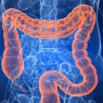 Καρκίνος Παχέος Εντέρου: Oι Θεραπευτικές Προσεγγίσεις και ο ρόλος της Φυσικής Άσκησης στην Ανάρρωση και την Πρόληψη