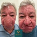 «Δεν μπορούσα ούτε να φιλήσω τη γυναίκα μου» – Η μύτη του μεγάλωσε τόσο που κάλυπτε το μισό του πρόσωπο – Δείτε πώς έγινε μετά την επέμβαση