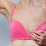 Σύγχρονες χειρουργικές προσεγγίσεις στον καρκίνο του μαστού