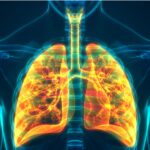 Χρόνια Αποφρακτική Πνευμονοπάθεια (ΧΑΠ)