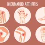 Ρευματοειδής αρθρίτιδα: Χτυπά ύπουλα και επώδυνα