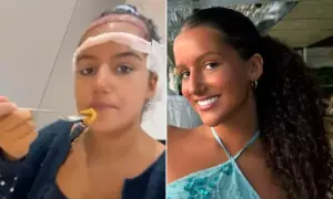 16χρονη από την Βρετανία ταξίδεψε στην Τουρκία για μεταμόσχευση μαλλιών - Το αποτέλεσμα έγινε viral